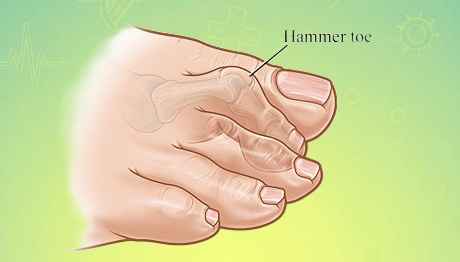 لا انگشتی همرتو (چکشی) طب و صنعت